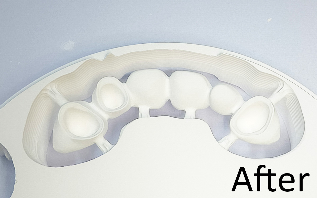 Six Ways to Reduce Zirconia Chipping on Thin Margins